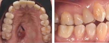 La mucormicosis rinocerebral es una infección oportunista infrecuente, con mayor prevalencia en inmunodeprimidos. Paciente Endodontico Con Mucormicosis Rinocerebral Reporte De Un Caso Sciencedirect