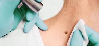 We did not find results for: Mole Removal Skin Cancer Screenings Key West Fl Islamorada Fl