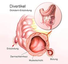 Blinddarmreizung Symptome Dauer Behandlung Test