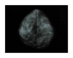 La mammographie le pivot du dépistage du cancer du sein. Mammographie