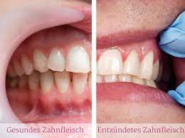 Zahnfleischentzundung Erkennen Und Richtig Behandeln Liebenswert Magazin
