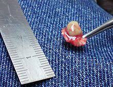 We did not find results for: Plantar Wart Wikipedia