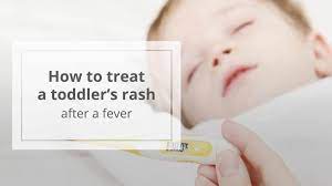 Rash After Fever When To Be Concerned