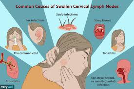 No lymphnode enlargement is not common after head injury and is unlikely to be related to it. Enlarged Cervical Lymph Nodes