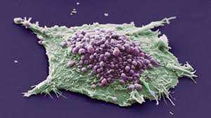 This can't always show the difference between cancer and some other lung condition, but it's pretty good at telling when things are clear. Why Do Never Smokers Get Lung Cancer Cancer Research Uk Cancer News