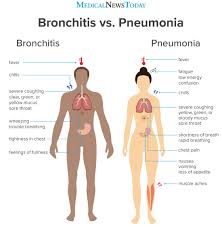 Pneumonia is an infection of the lungs that can be caused by a variety of different pathogens, including viruses, bacteria, fungi. Bronchitis Vs Pneumonia How To Tell