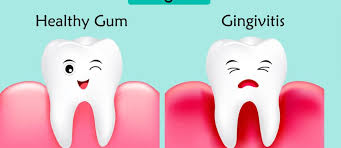 Consult a doctor for medical advice. 16 Home Remedies For Gingivitis Including Foods Some Best Tips