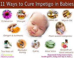 11 Natural Ways Of Treating Impetigo In Babies Impetigo Facial Warts Skin Diseases
