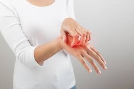 Maybe you would like to learn more about one of these? Mengenal Dan Menangani Dermatitis Numularis Yang Sering Dikira Kurap Alodokter