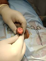 Image result for balanoposthitis