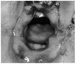 Child Abuse In Saudi Arabia Report Of Ten Cases Annals Of Saudi Medicine