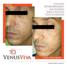 Bio Oil Before And After Face Pin On Firmaskin