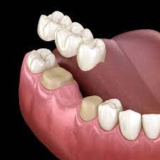 Maybe you would like to learn more about one of these? Dental Bridge Milwaukee Wi Czaplicki Family Dentistry