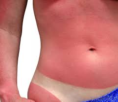 Sunburns usually last a few days to a week or more. What Is Helioplex With Pictures