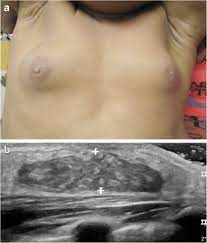 Mini-puberty of infancy in a 16-month-old girl with prominent breast... |  Download Scientific Diagram
