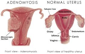 So if you consider that the ultimate way or making the diagnosis is to. Adenomyosis Endometriosis Symptoms Adenomyosis Treatment Endometriosis