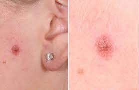 Image result for Spitz Nevus