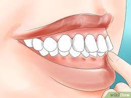 Nevertheless, i really want to get braces. How To Determine If You Need Braces With Pictures Wikihow