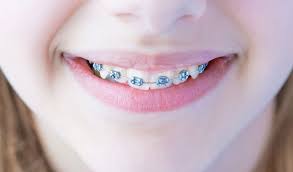 Knowing how to clean braces properly is essential. Your Teeth Need To Be Properly Cared For With Braces Orthodontic Blog Orthodontic Specialists Of Lake Countyorthodontic Blog Orthodontic Specialists Of Lake County