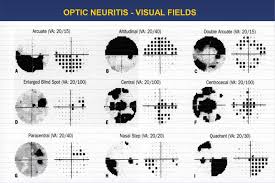 Image result for Visual Field Deficit