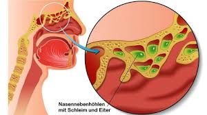 Nasenschmerzen und nasenerkrankungen sind nicht immer harmlos und können schwerwiegende folgen mit sich bringen, insbesondere wenn sich eine entzündung auf augen oder gehirn ausbreitet. Nasennebenhohlenentzundung Ursachen Beschwerden Therapie Gesundpedia De
