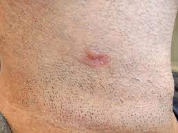 Nodules of basal cell carcinoma can be apparent in late lesions but the sclerotic scarred area can expand to a very large size before it is clinically obvious as a skin cancer. Disease Management Nonmelanoma Skin Cancer