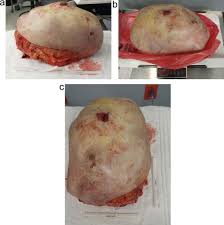 If your tumor is malignant, you may need more aggressive surgery and other treatment. Aggressive Malignant Phyllodes Tumor Sciencedirect