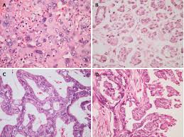 E&amp;e calretinin e&amp;e calretini n tubulopapillary mesothelioma component: Clinical Characteristics And Survival Of Patients With Normal Sized Ovarian Carcinoma Syndrome Retrospective Analysis Of A Single Institution 10 Year Experiment