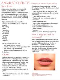 Image result for Angular Stomatitis