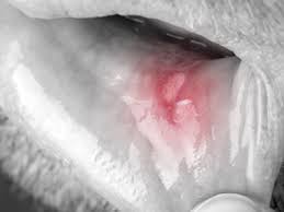 How to cure canker sores overnight naturally at home. Cure Canker Sores At Home Health Dailylife Lk Sri Lanka