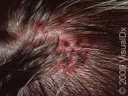 Image result for white scabs on the head in children