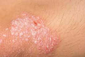 A psoríase é uma condição inflamatória crônica da pele que afeta aproximadamente de 1 a 3% da população mundial. O Que E A Psoriase Atlas Da Saude