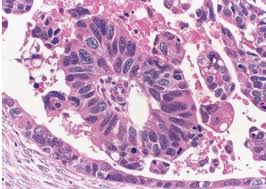 Ways to know if you have ovarian cancer. Ovarian Cancer