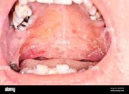 Image result for oral thrush symptoms roof of the mouth