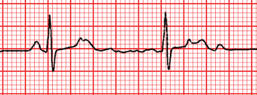 Image result for Extrasystole