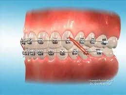 If you have actually used braces enough time, you might begin to wonder how you can accelerate the aligning procedure. Advanced Orthodontics Elastics Youtube