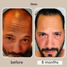 Beard or no beard. 🤔 From dating apps for beard lovers to No-Shave  November — yes, an entire month dedicated to growing facial hair — beards  seem to be everywhere. But are