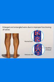 Pin On Https Compressionstockings In