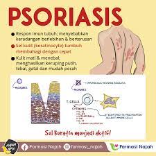 Elenco dei prodotti per produttore psoriasis. Farmasi Najah Psoriasis Apakah Itu Psoriasis Facebook