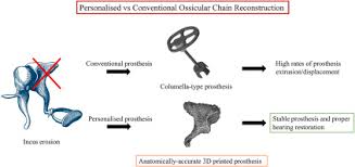 Image result for Ossicular Chain Disruption