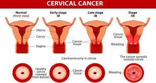 If the cancer spreads out of your cervix and into surrounding tissue and organs, it if the results of the biopsy suggest you have cervical cancer and there's a risk that the cancer may have spread, you'll probably need to have some further tests to assess how widespread. Cervical Cancer Health Tips Cervical Cancer Health Articles Health News Thehealthsite Com