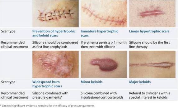 Scar Treatment Advice Current Treatments for the Treatment of Scars