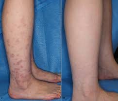 Image result for erythema nodosum