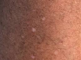 Hypomelanosis Guttata Altmeyers Enzyklopadie Fachbereich Dermatologie