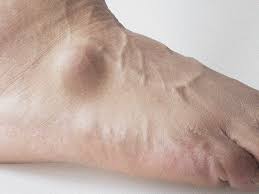 In order to know how to get rid of a cyst, here are some of the steps that you should follow. Ganglion Cyst On Foot Pictures Cause Symptoms And Treatment