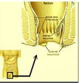 Malasana is one of the best yoga asanas for piles. Yoga For Piles Piles And Yoga Yoga Postures For Piles Piles Yoga Yoga Piles Treatment Yoga For Piles Cure