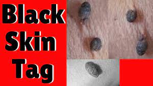 Skin tags are usually found on the neck, armpits, around the groin. Question What Happens If A Skin Tag Turned Black 2021