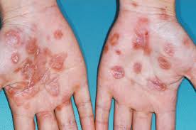 Image result for Secondary Syphilis