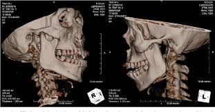 Image result for Jaw Dislocation