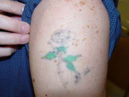 Call 020 7993 4849 today to book a surgical tattoo removal consultation. Laser Tattoo Removal Daytona Beach Fl Ormond Beach Tattoo Removal